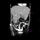 Liver metastases, carcinoid: CT - Computed tomography
